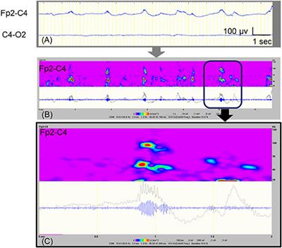 Case Report: High-Gamma Oscillations on an Ictal Electroencephalogram in a Newborn Patient With Hypoxic–Ischemic Encephalopathy